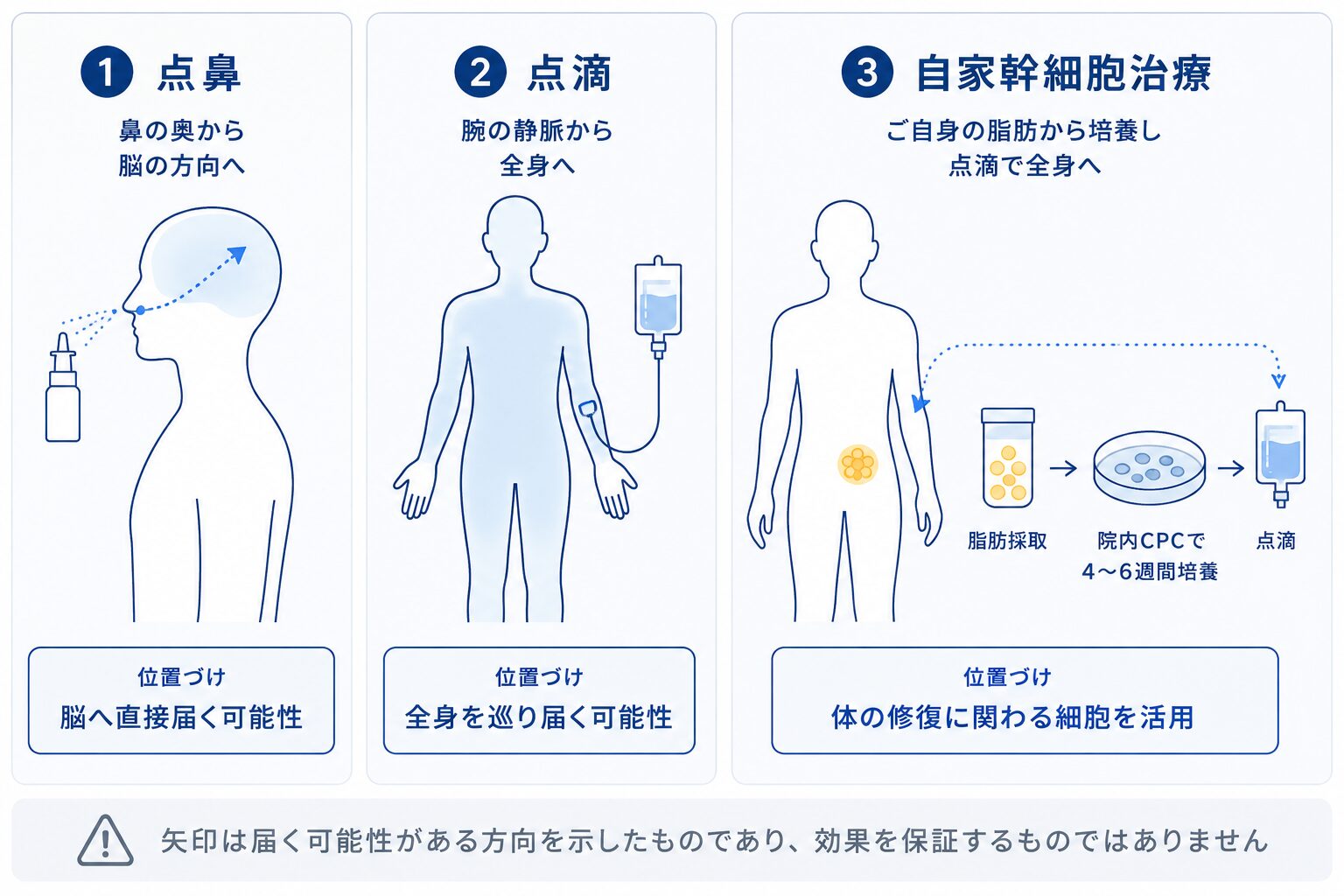 脳卒中後遺症で検討される投与方法(点鼻・点滴・幹細胞治療)と、それぞれの位置づけを示した図解